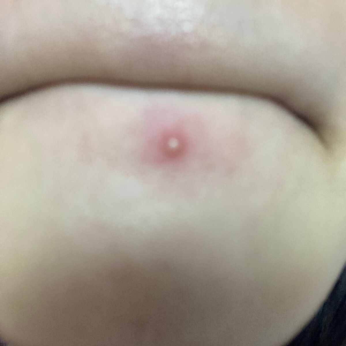 プロCICA クリアスポットパッチ/VT/その他スキンケアを使ったクチコミ(2枚目)