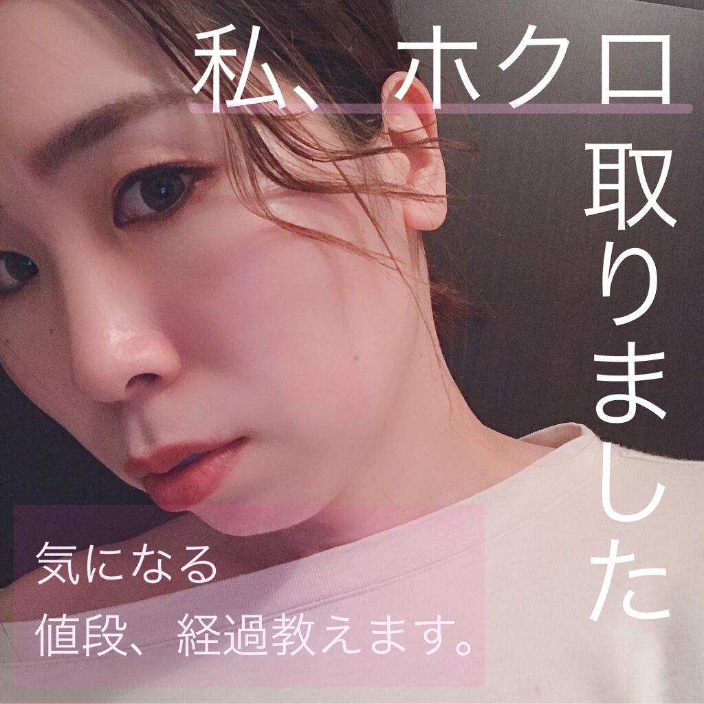 MOCA on LIPS 「【ホクロ除去体験】垢抜けには必須!*個人の体験になりますので全..」(1枚目)