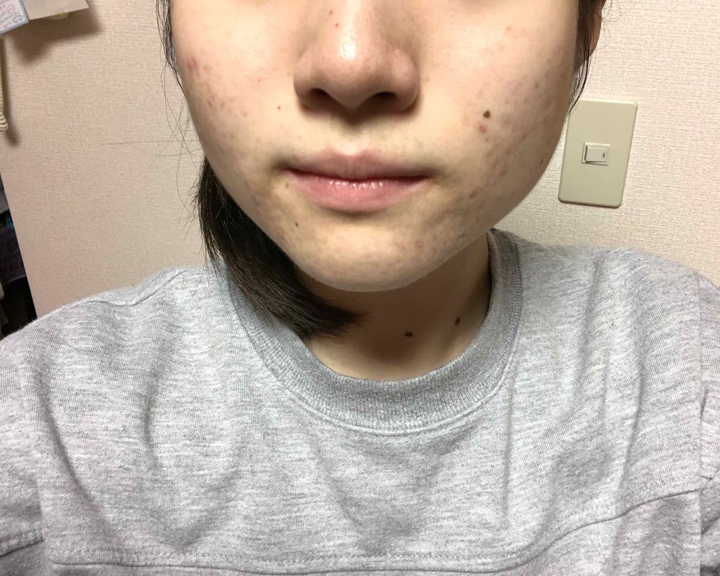 マンスリースキンケアプログラム(旧)/APEX/スキンケアキットを使ったクチコミ(2枚目)