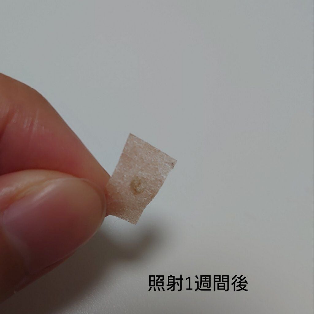 a on LIPS 「湘南のシミ取りレーザー10してきました!濃いシミがあるってわけ..」(4枚目)