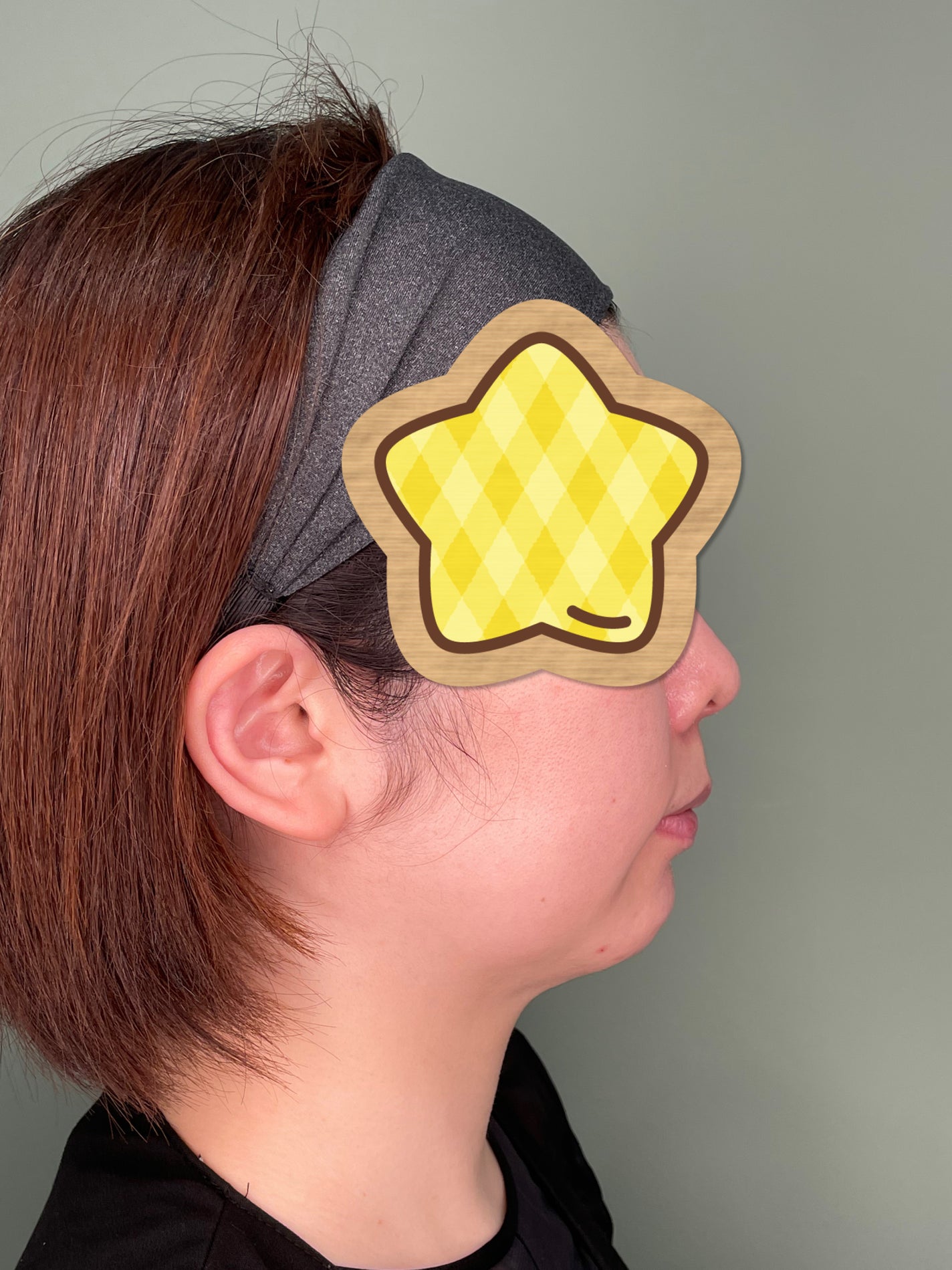 め@フォロバします on LIPS 「顎プロテーゼをやって半年経ったので記録。写真は術前1週間後1ヶ..」(5枚目)