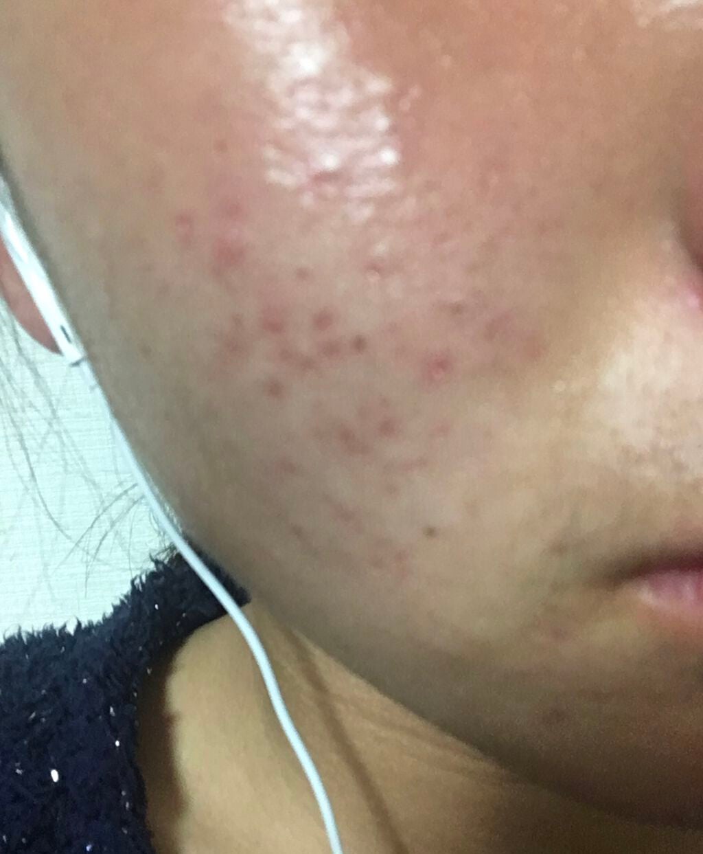 ニキビあとケアジェル/アットノン/その他スキンケアを使ったクチコミ(3枚目)