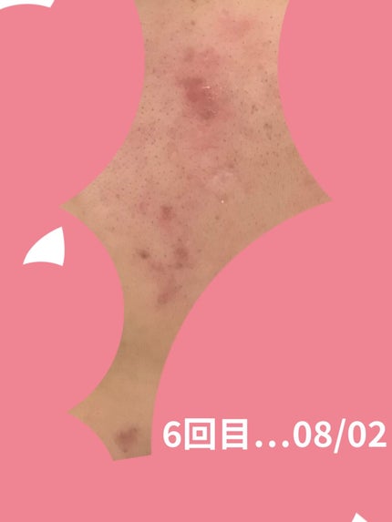 ダーマエアショット/MEDICUBE/美顔器・マッサージを使ったクチコミ(2枚目)