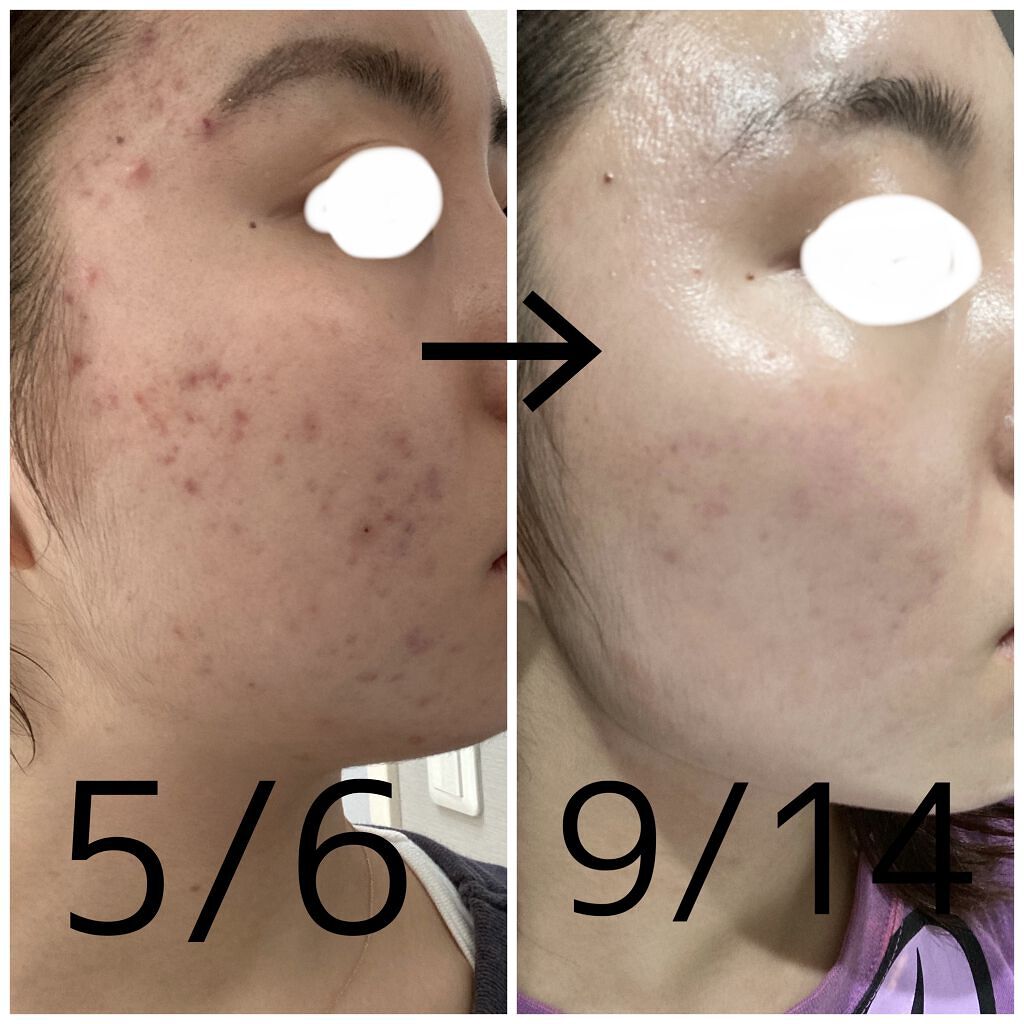 十味敗毒湯(医薬品)/ツムラ/その他を使ったクチコミ（1枚目）