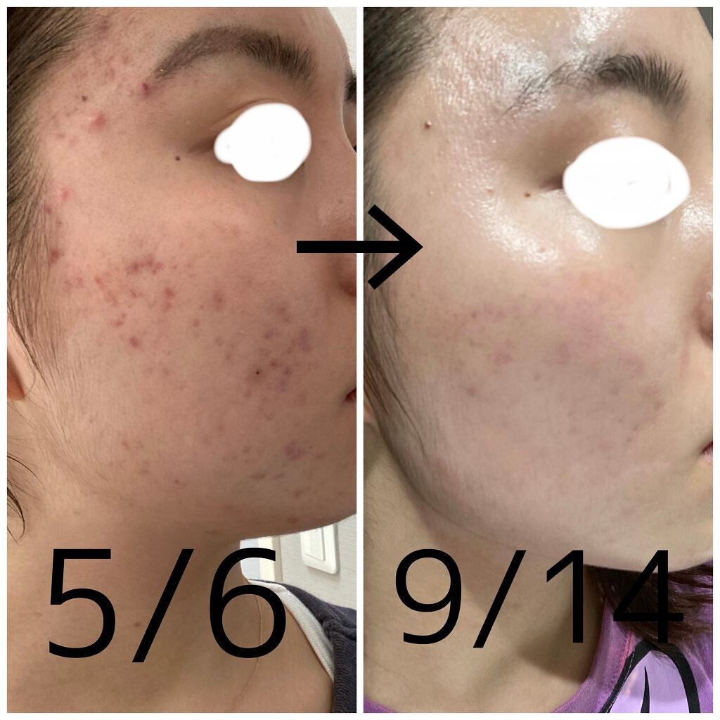 十味敗毒湯(医薬品)/ツムラ/その他を使ったクチコミ(1枚目)