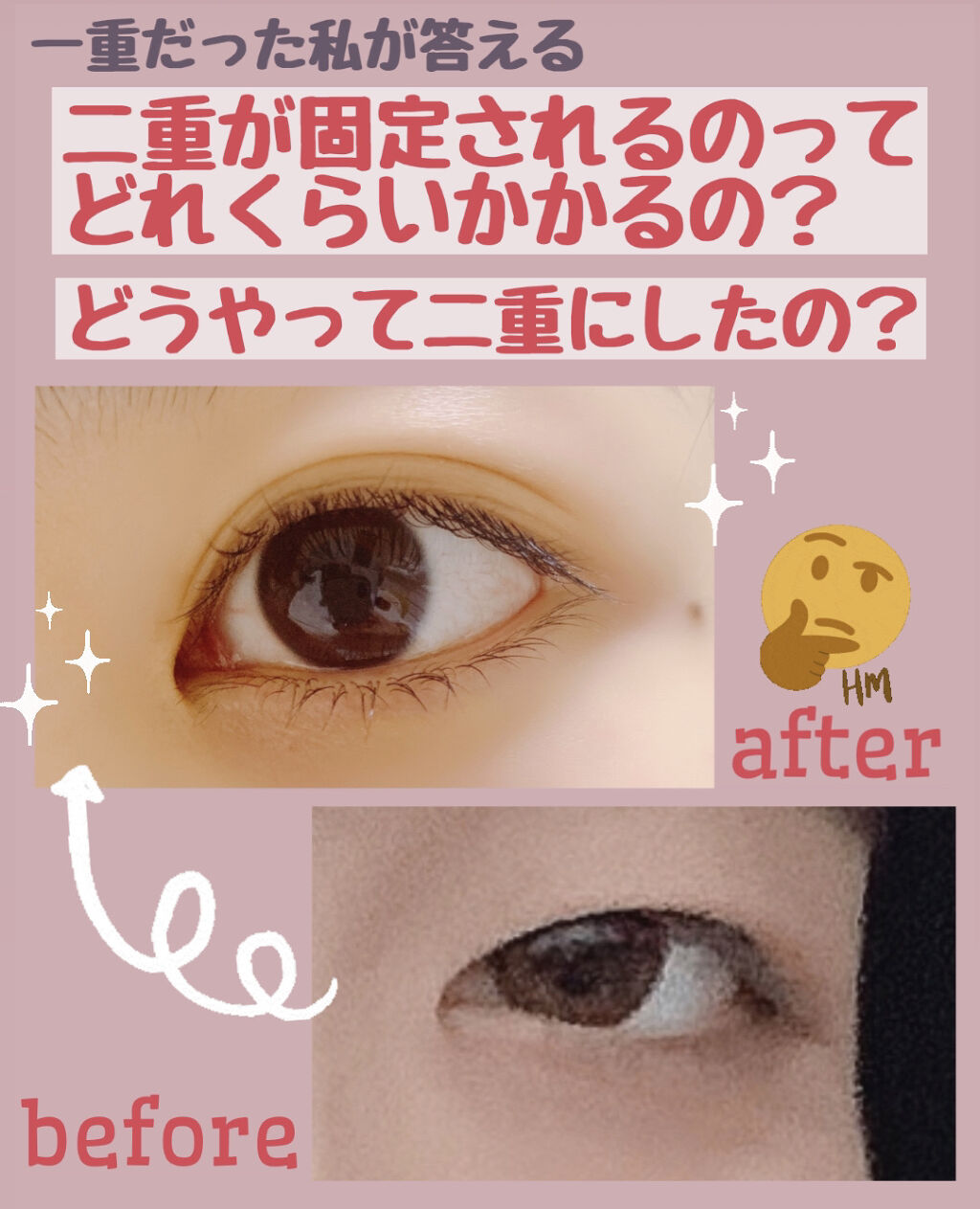 アイトーク/アイトーク/二重まぶた用アイテムを使ったクチコミ（1枚目）