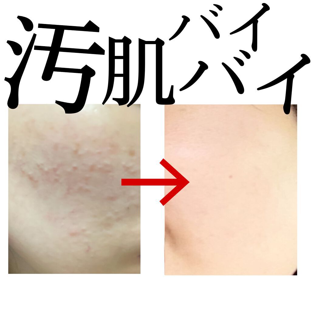 皮脂トラブルケア 化粧水/キュレル/化粧水を使ったクチコミ（1枚目）