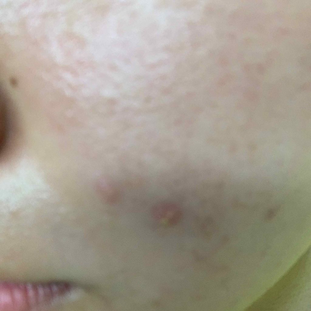 エピデュオゲル/マルホ株式会社/その他を使ったクチコミ（1枚目）