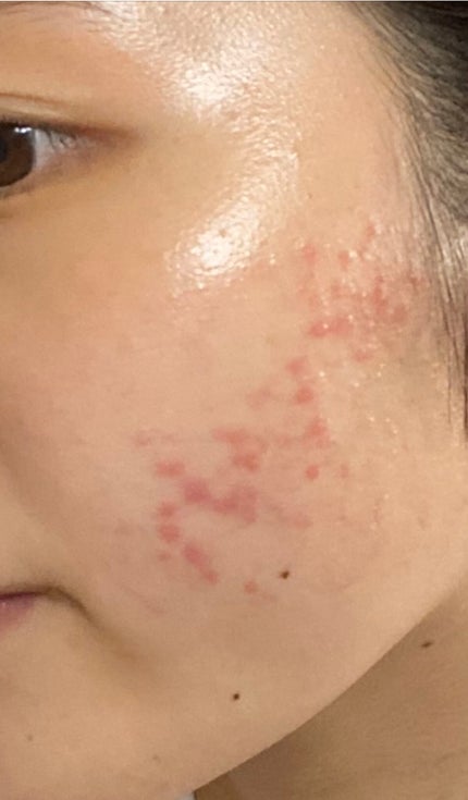 薬用しみ集中対策 プレミアム美容液/メラノCC/美容液を使ったクチコミ(3枚目)