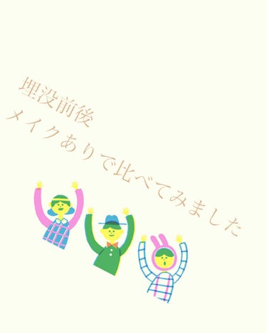 埋没前は絆創膏→アイプチ二度重ねで、元の奥二重の線が出つつも、何とか二重を作っていました！

埋没後は、経過約二ヶ月後ですが、元の二重の線もなくなるぐらいぱっちり二重になりました。

経過はかなり長かっ