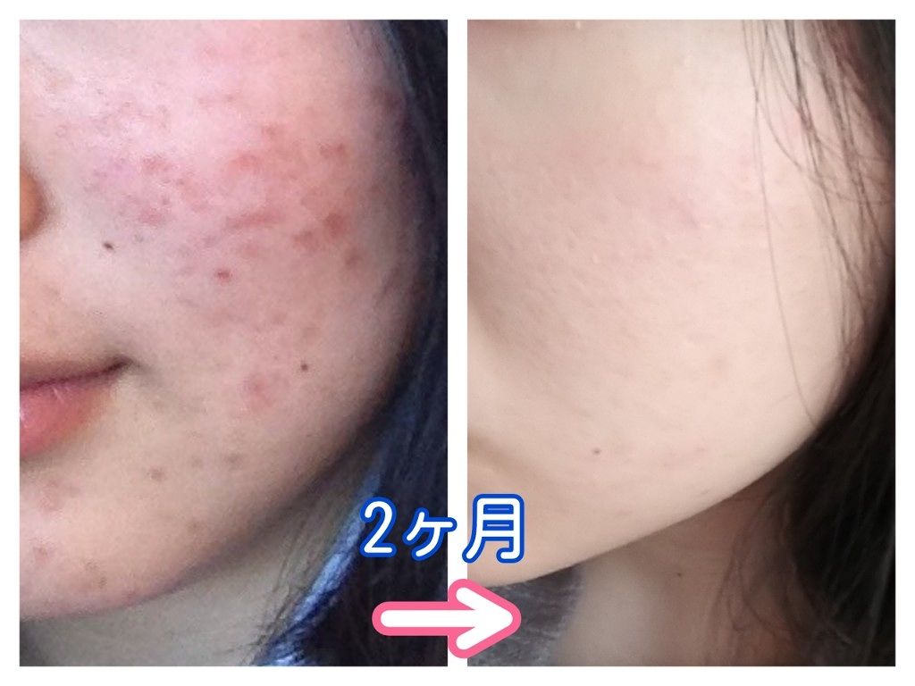 オロナインH軟膏 (医薬品)/オロナイン/その他を使ったクチコミ(2枚目)