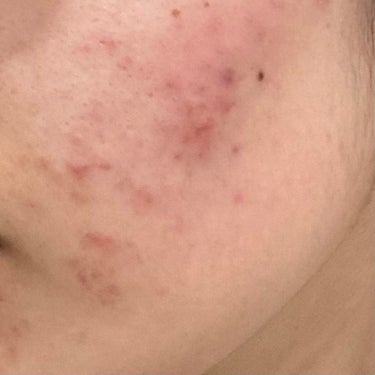 なまけもの on LIPS 「汚肌失礼します、、頬のニキビを潰して皮膚をむしってしまいました..」（1枚目）