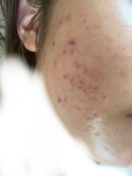 レチノールA 1% アドバンスドリバイタリゼーションクリーム/Life-flo/フェイスクリームを使ったクチコミ(2枚目)