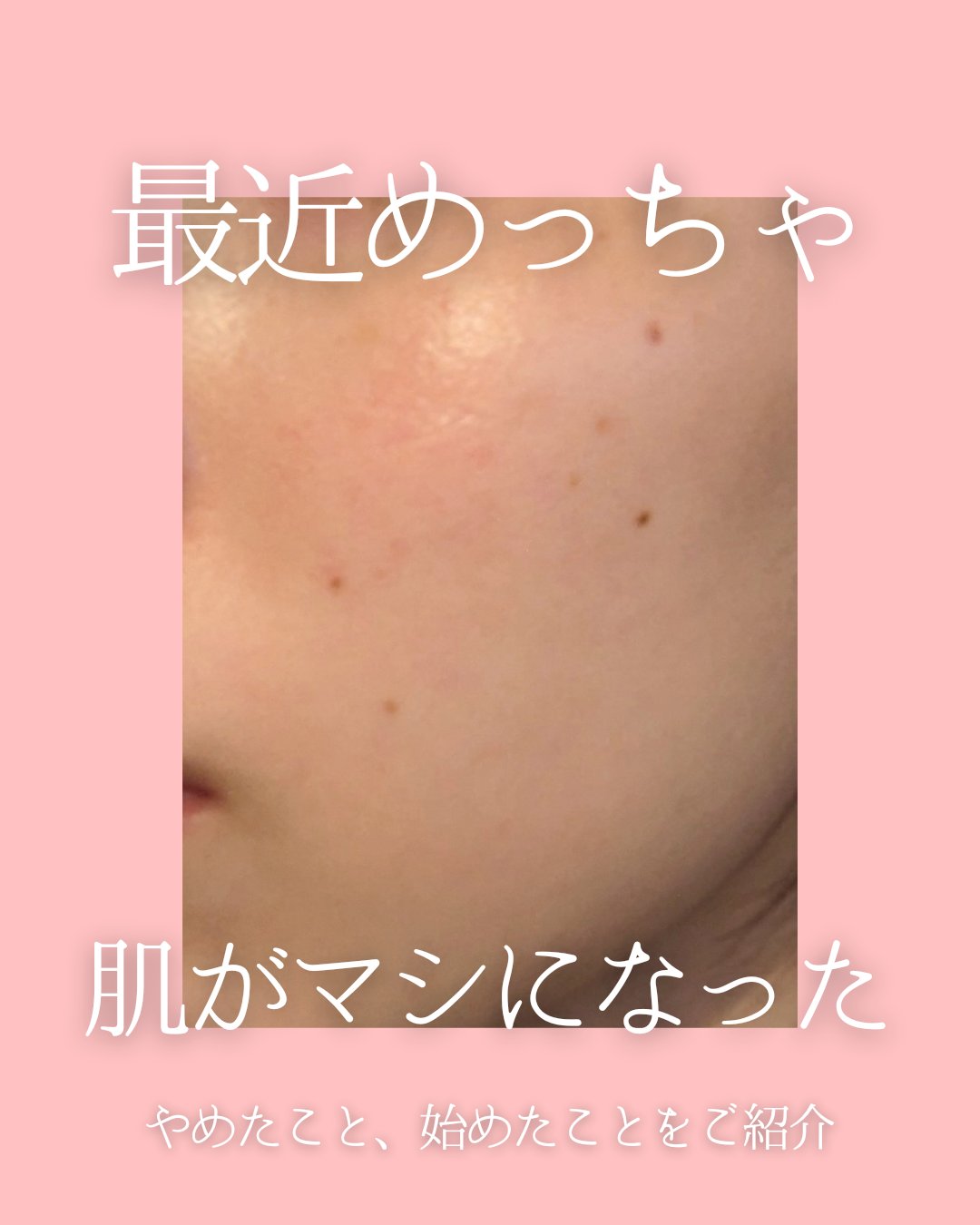 最近めっちゃ肌の調子がマシになったので、未来の自分が肌荒れした時見返せるように今やっていることを書いておこうと思います✍

私の肌質について！
・インナードライで鼻は油田なのに他は砂漠
・混合肌だけど乾燥肌寄りのスキンケアが合う
・頬の皮膚