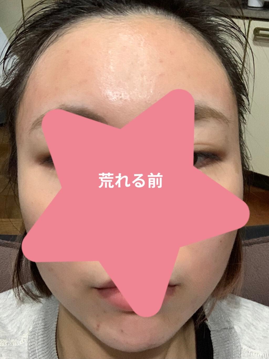 〇〇 on LIPS 「ニキビが治らなすぎてむしろ悪化したので皮膚科へ行きました。最初..」(2枚目)