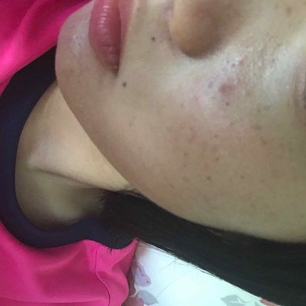 ケアアクネ 薬用 ジェルスポッツ/ナリス化粧品/美容液を使ったクチコミ(2枚目)