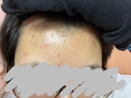 薬用しみ対策 美白化粧水/メラノCC/化粧水を使ったクチコミ(2枚目)