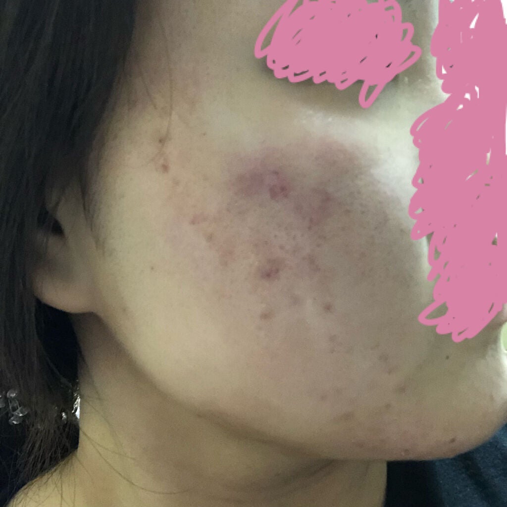 もうすぐ社会人になる人。 on LIPS 「〈!!!!!!!!閲覧注意!!!!!!!!〉【ニキビ治療経過記..」(4枚目)