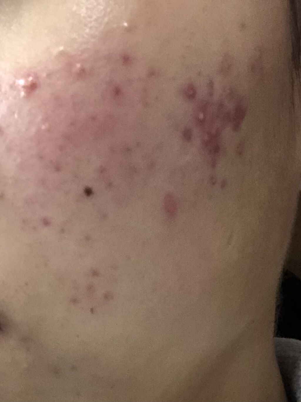 薬用ＡＩＤソープ/フィジカル/洗顔石鹸を使ったクチコミ（1枚目）