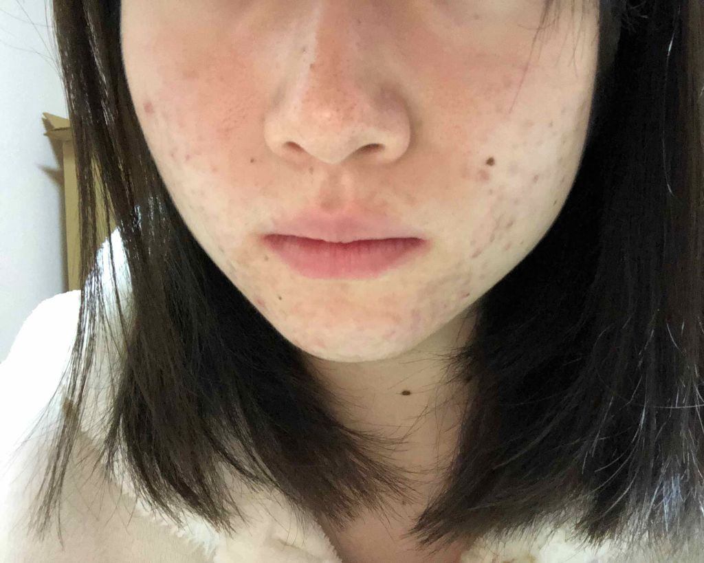 マンスリースキンケアプログラム(旧)/APEX/スキンケアキットを使ったクチコミ(2枚目)