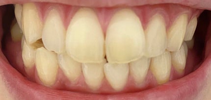 クリアクリーンプラスホワイトニング薬用デンタルリンス アップルミント/クリアクリーン/マウスウォッシュ・スプレーを使ったクチコミ(2枚目)