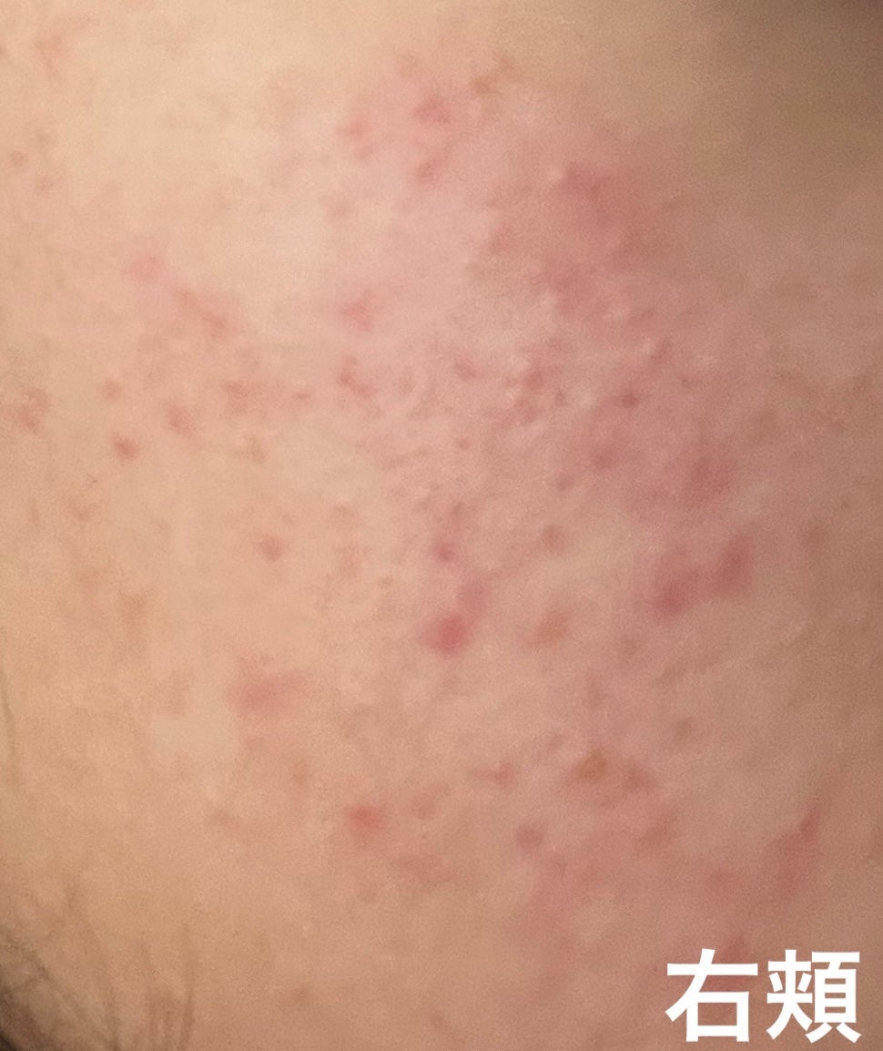 ニキビ治療薬(医薬品)/メンソレータム アクネス/その他を使ったクチコミ(3枚目)