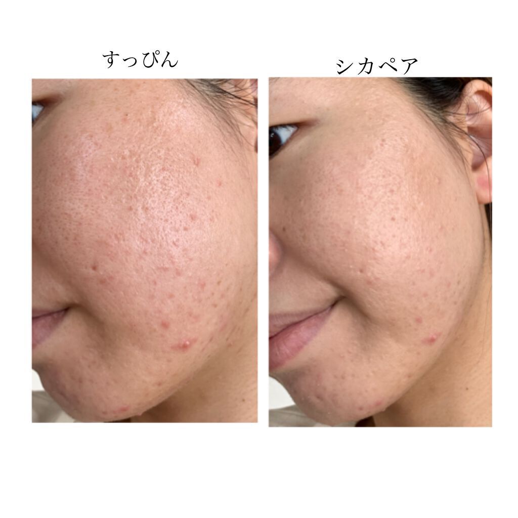 ドクタージャルト シカペア リカバー (第2世代)/Dr.Jart+/フェイスクリームを使ったクチコミ(6枚目)