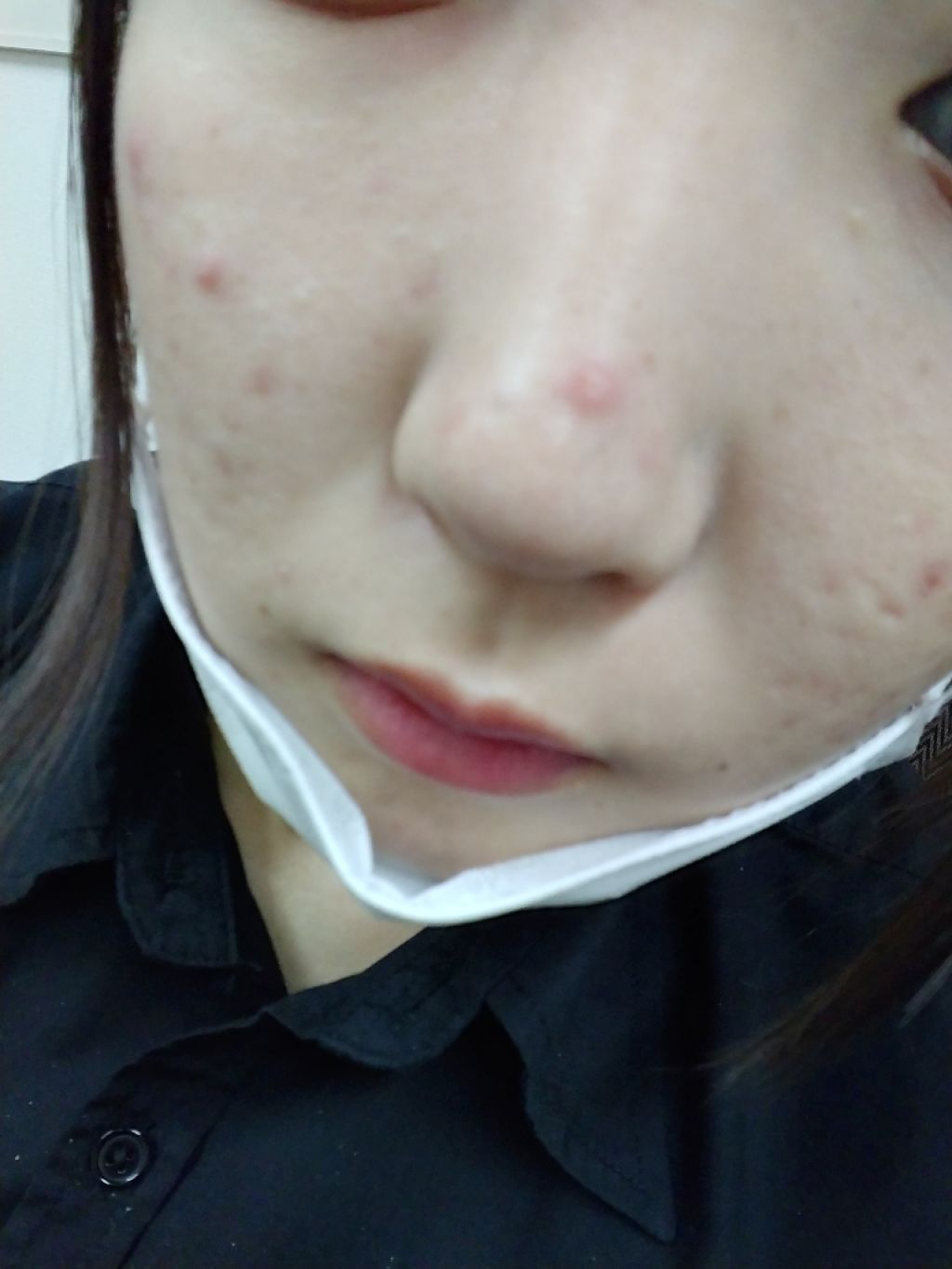 ペアアクネクリームW(医薬品)/ペア/その他を使ったクチコミ（3枚目）