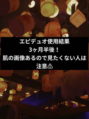 お目汚し失礼します。

エピデュオ使用して3ヶ月半が経ったので記録です。
化粧水、乳液はずっとdプログラムを使っていて美容液として無印良品の美白美容液を使用してます。
もう副作用も出なくなったし、ニキビ