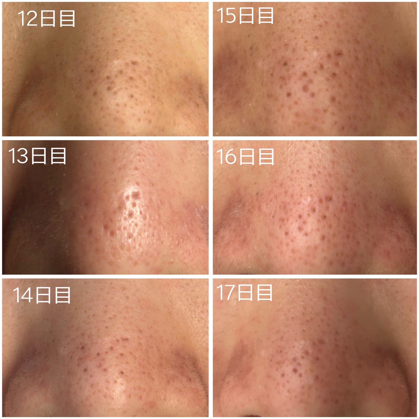 毛穴アンプル/ブラン/美容液を使ったクチコミ(4枚目)