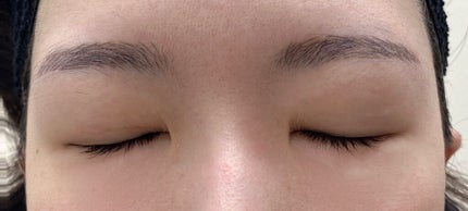 二重整形/その他を使ったクチコミ(2枚目)