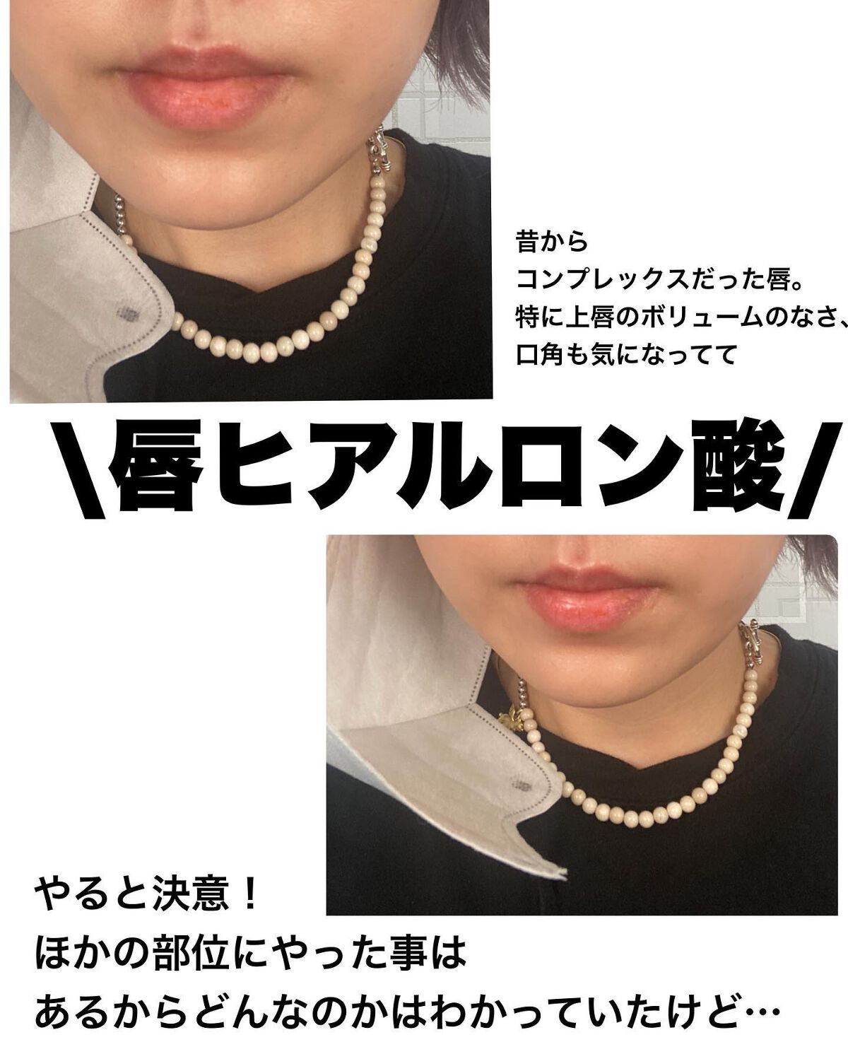 りっちゃん on LIPS 「やって良かった美容医療💉唇ヒアル💋/⚠️唇写真たくさん出ます昔..」(2枚目)