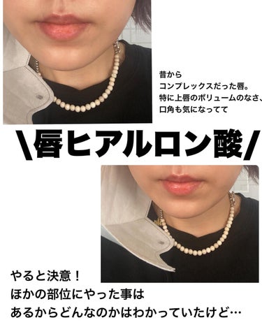 りっちゃん on LIPS 「やって良かった美容医療💉唇ヒアル💋/⚠️唇写真たくさん出ます昔..」（2枚目）