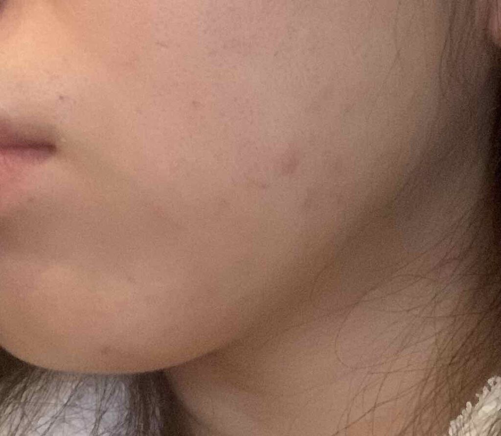 ディフェリンゲル0.1% /マルホ株式会社/その他を使ったクチコミ（3枚目）