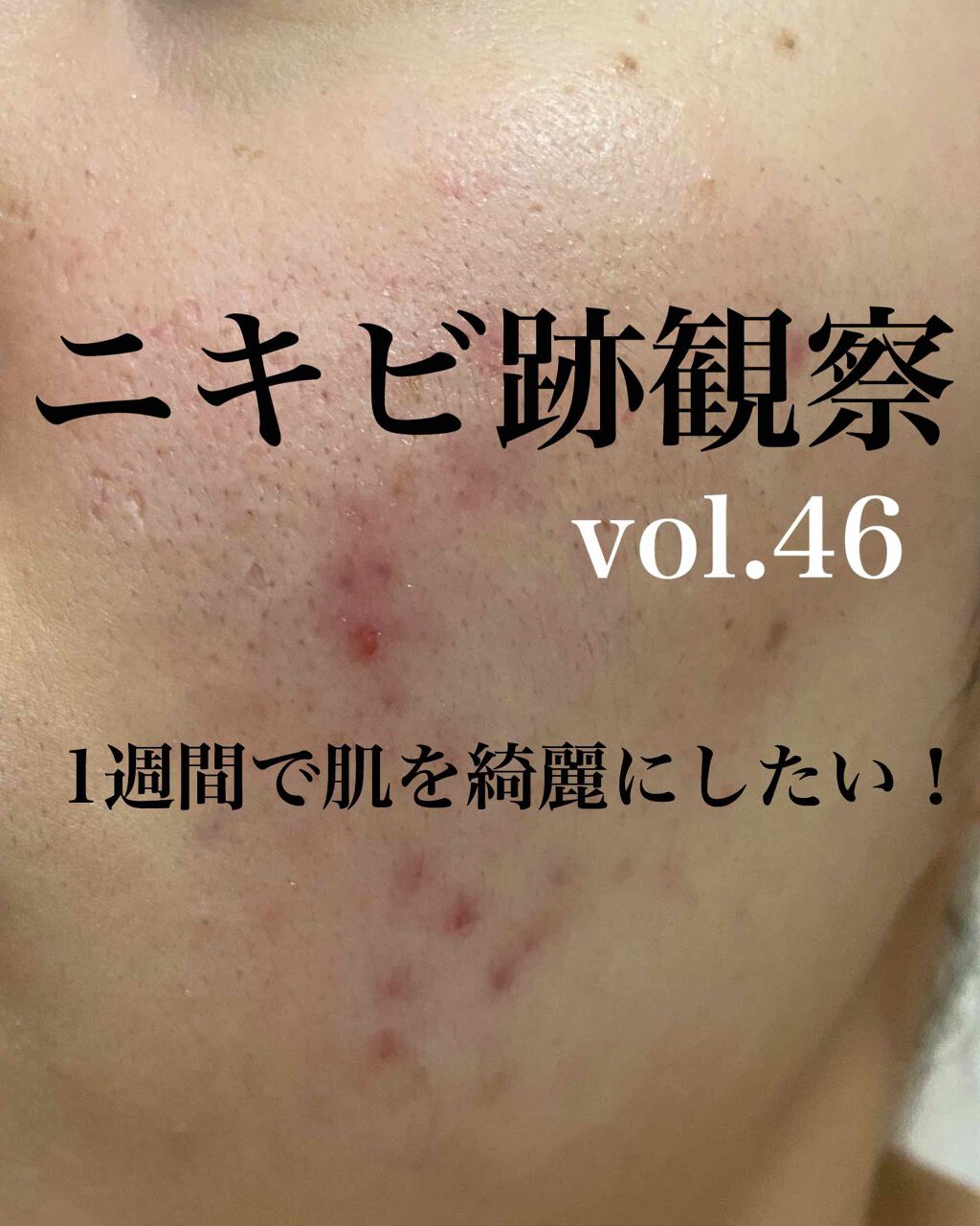 FDR アクネケア 洗顔クリーム/ファンケル/洗顔フォームを使ったクチコミ（1枚目）