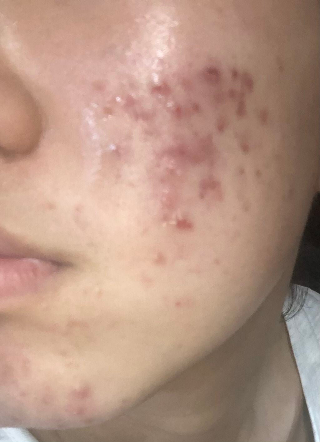 ❤︎𝐑𝐄𝐈𝐊𝐀❤︎ on LIPS 「最近ニキビに大変悩んでいます。私はニキビが出来たらすぐ潰してし..」(1枚目)