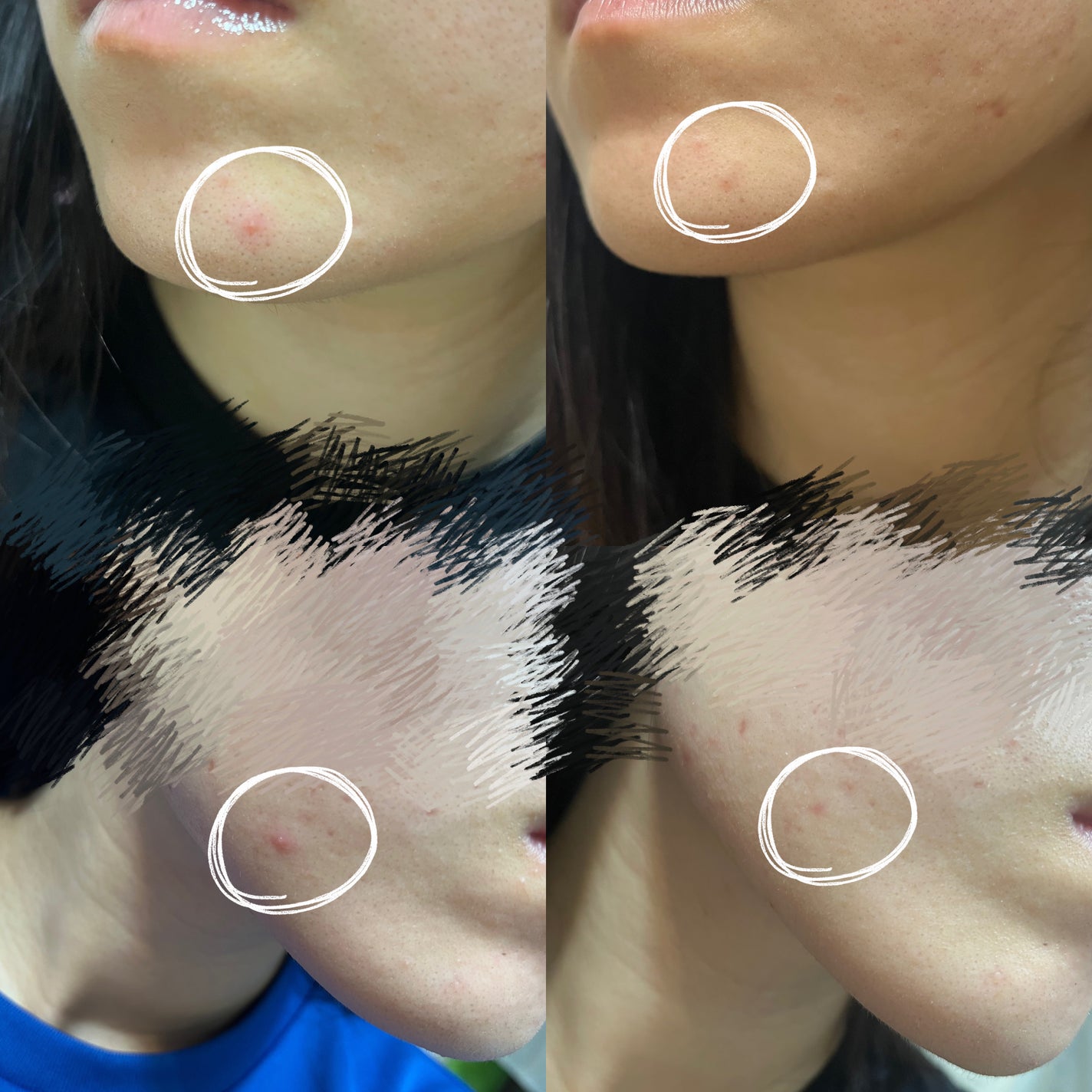 ペアアクネクリームW(医薬品)/ペア/その他を使ったクチコミ(2枚目)