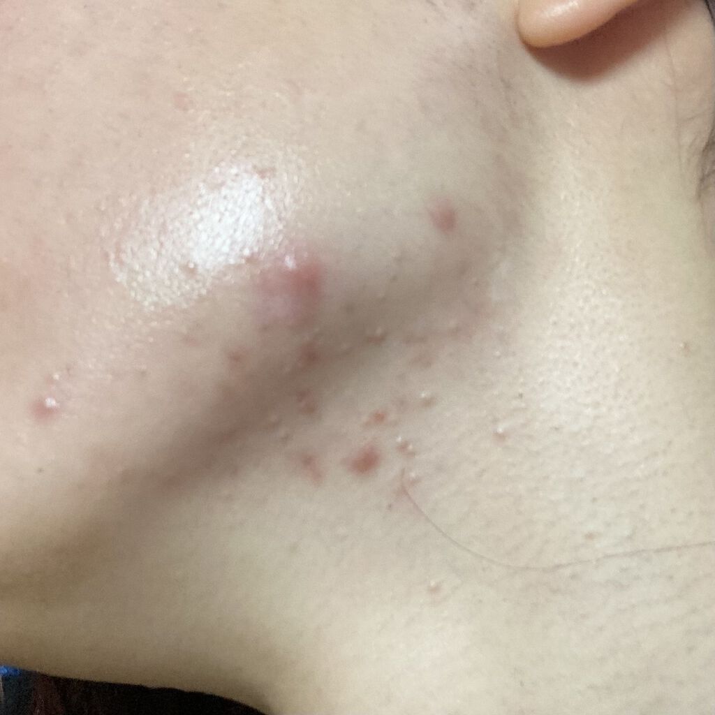 オードムーゲ 薬用ローション（ふきとり化粧水）/オードムーゲ/拭き取り化粧水を使ったクチコミ（2枚目）