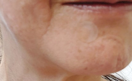 エイクリアスポットキュアパッチ/Dr.G/その他スキンケアを使ったクチコミ(4枚目)