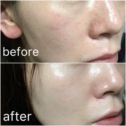 リンクルショット メディカル セラム/リンクルショット/アイケア・アイクリームを使ったクチコミ(4枚目)