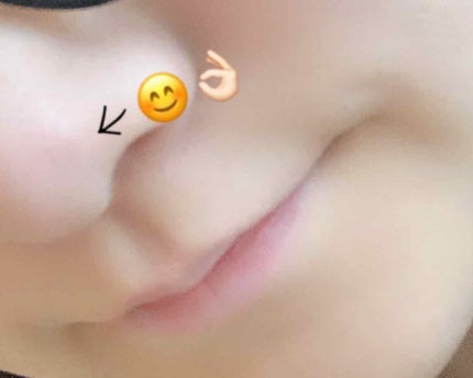 あす on LIPS 「みなさん!ニキビやニキビ跡でお困りの方いませんか?私はもともと..」(4枚目)