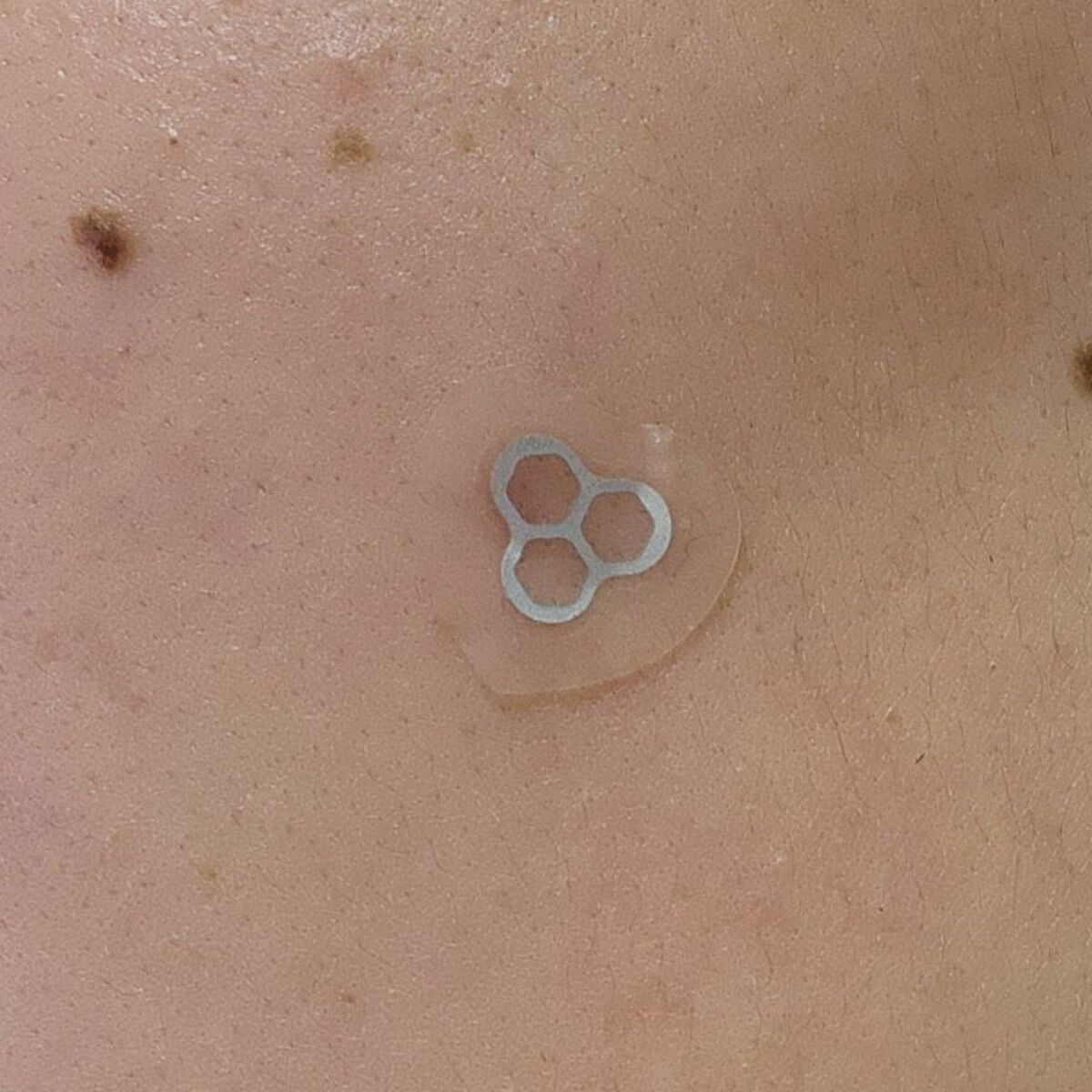 ACマグネシウムパッチ ミニ/スノーツープラス/にきびパッチを使ったクチコミ(4枚目)