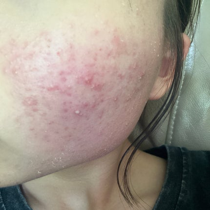 ペアアクネクリームW(医薬品)/ペア/その他を使ったクチコミ(2枚目)