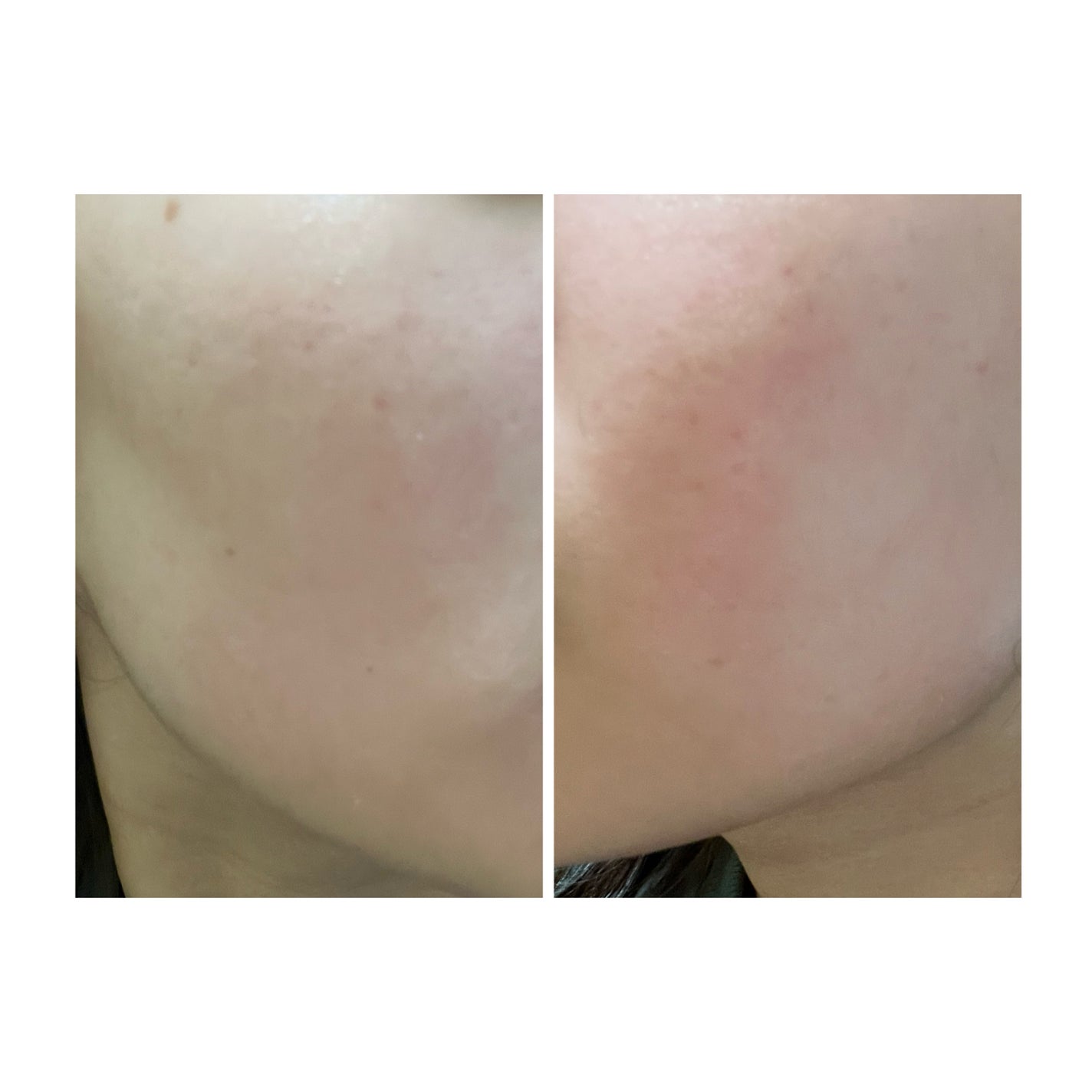 ぽむ on LIPS 「2023.9.13皮膚科に受診 エピデュオとヘパリン処方1枚目..」(2枚目)