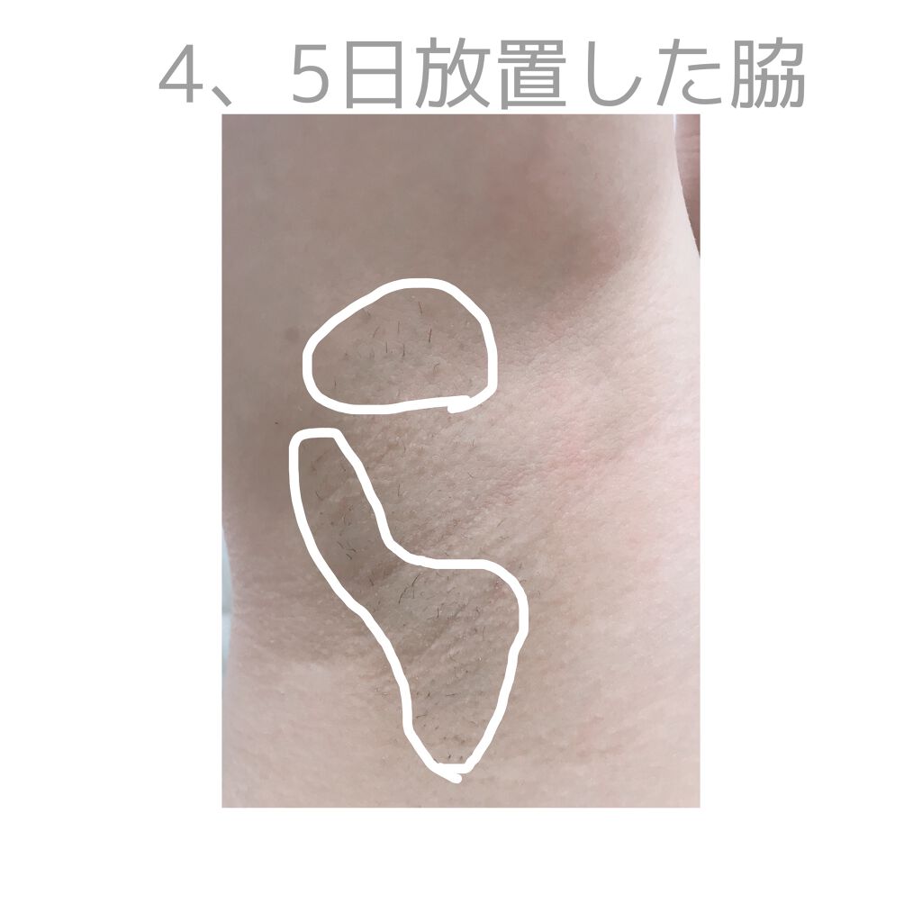 光美容器KE-NON(ケノン)/エムテック/家庭用脱毛器を使ったクチコミ(5枚目)