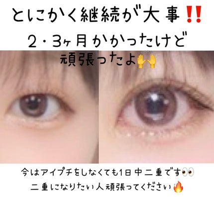 カワイクなりたい🎀フォロバ100% on LIPS 「みなさんお久しぶりです💦今回は私が一重から二重になった方法を紹..」(4枚目)