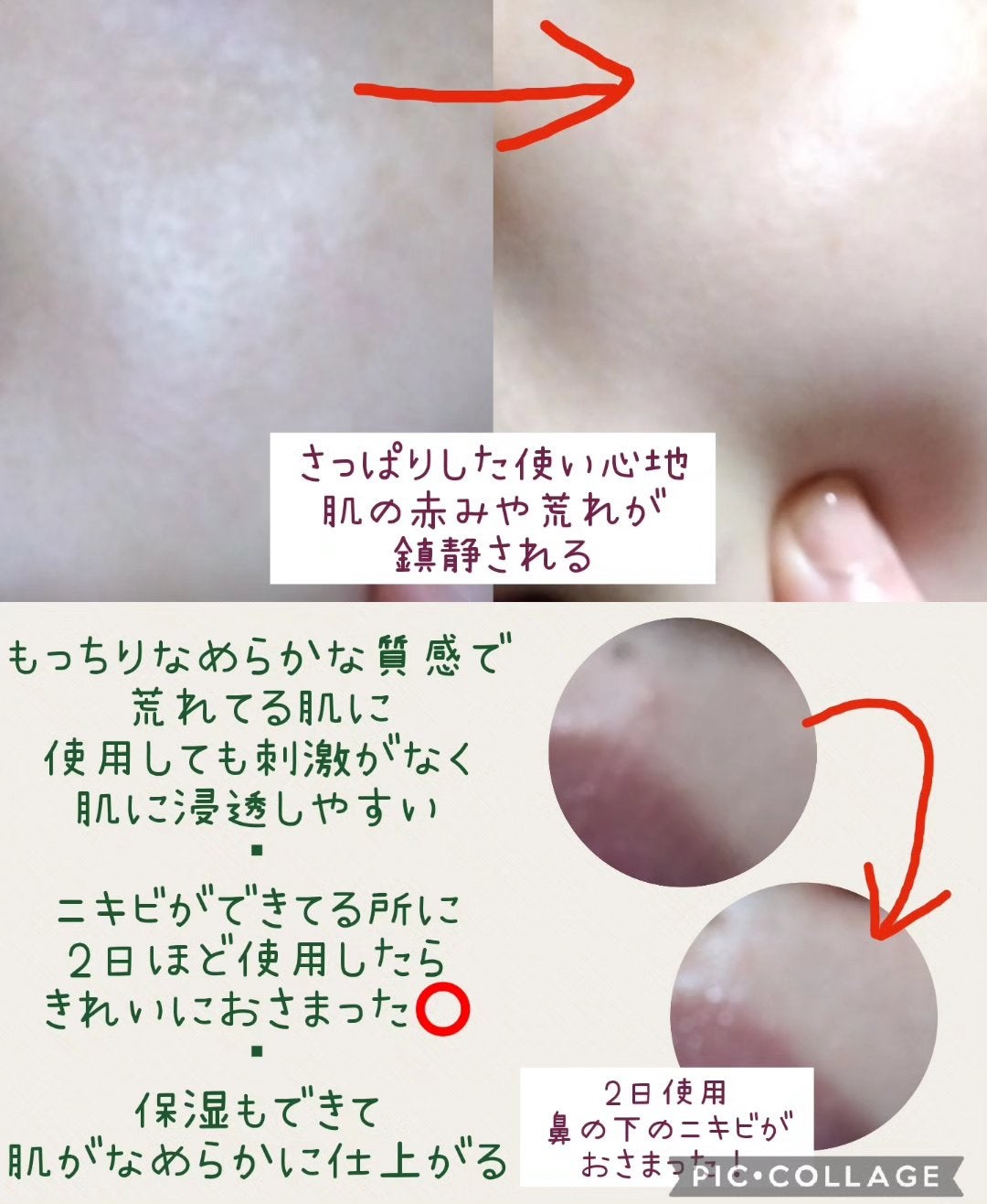 アキュリアルナインコントロールエックスクリーム/ACWELL/フェイスクリームを使ったクチコミ(3枚目)