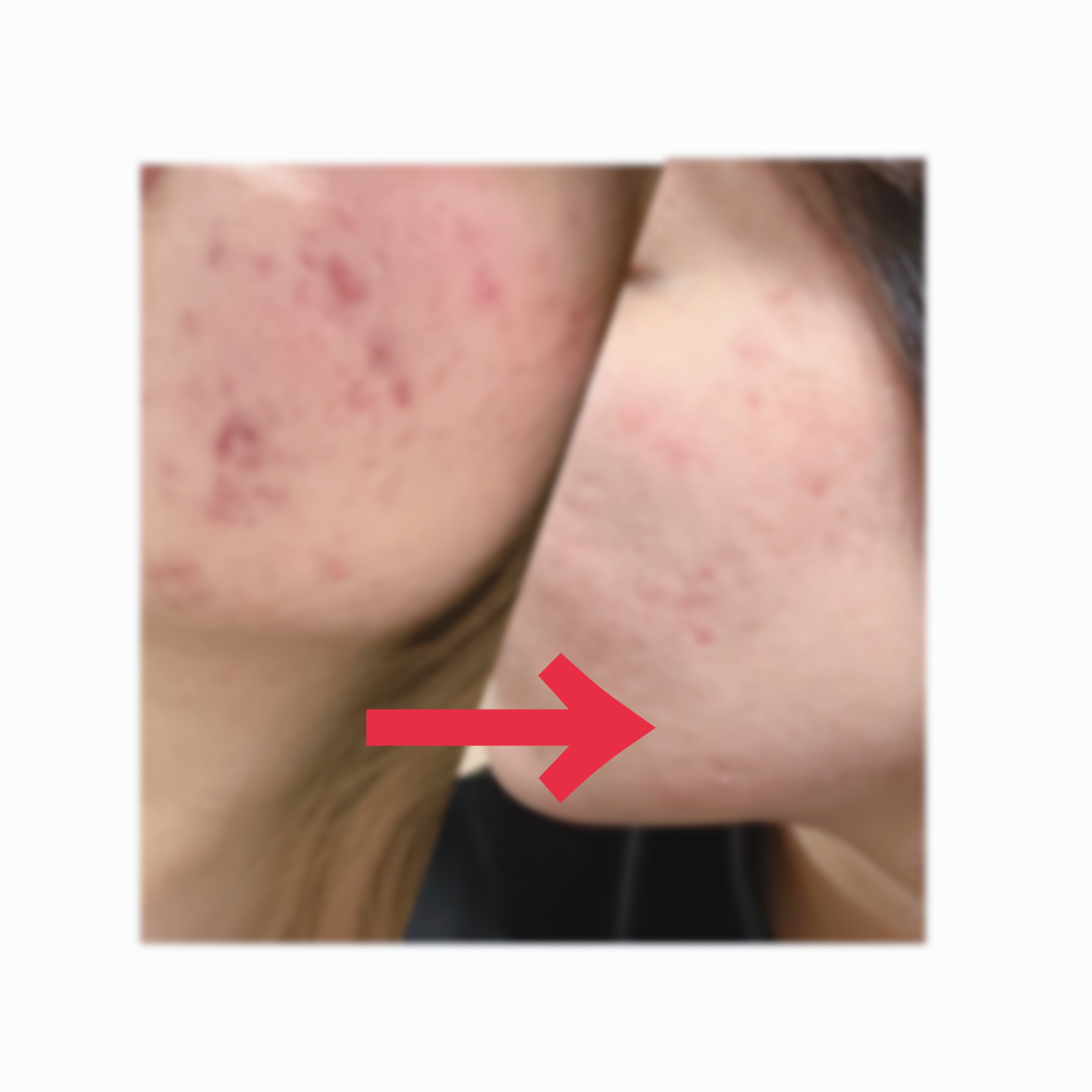 極潤ヒアルロン液（ハダラボモイスト化粧水d）/肌ラボ/化粧水を使ったクチコミ（2枚目）