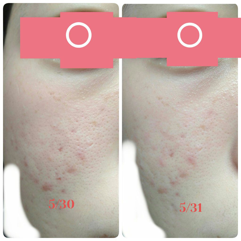 ベピオゲル/マルホ株式会社/その他を使ったクチコミ（2枚目）