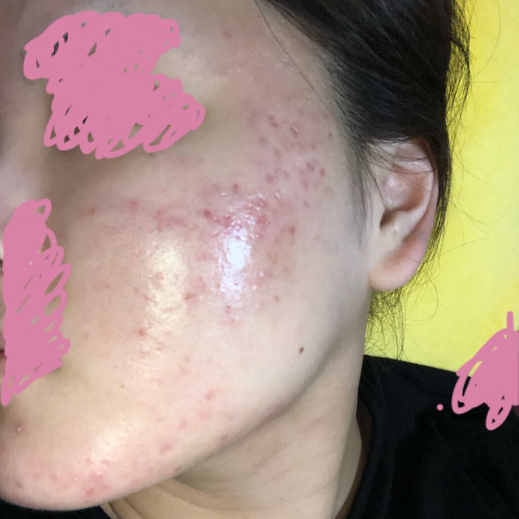 もうすぐ社会人になる人。 on LIPS 「〈!!!!!!!!閲覧注意!!!!!!!!〉【ニキビ治療経過記..」(1枚目)